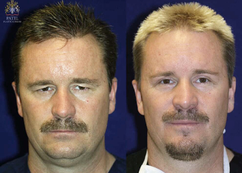 upper blepharoplasty before and after patient 1