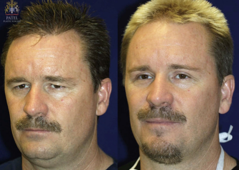 upper blepharoplasty before and after patient 2