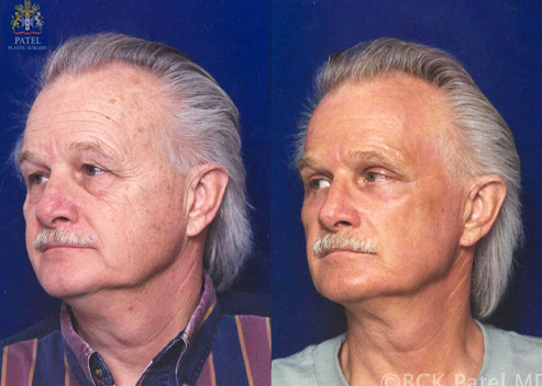 upper blepharoplasty before and after patient 3