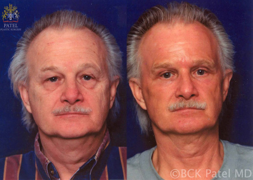 upper blepharoplasty before and after patient 4