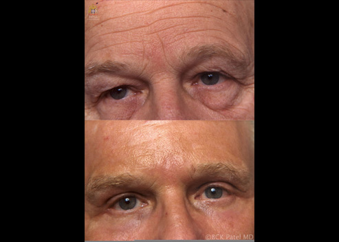 upper blepharoplasty before and after patient 5