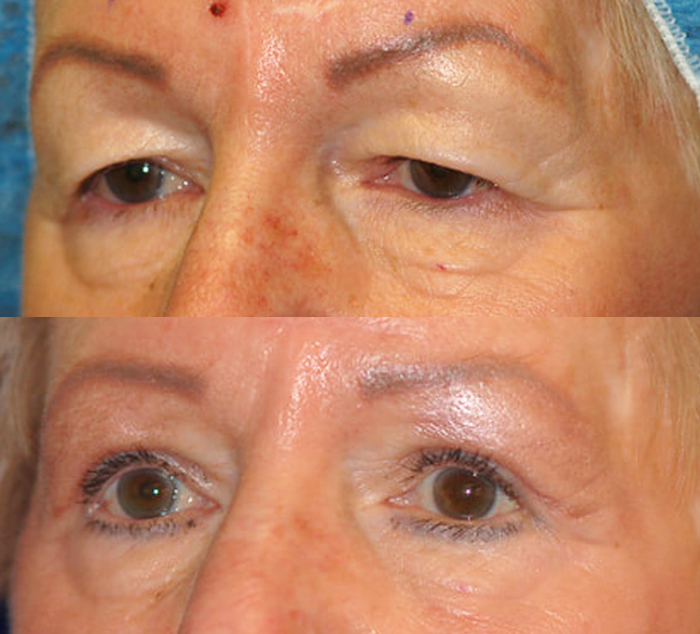 upper blepharoplasty patient 1