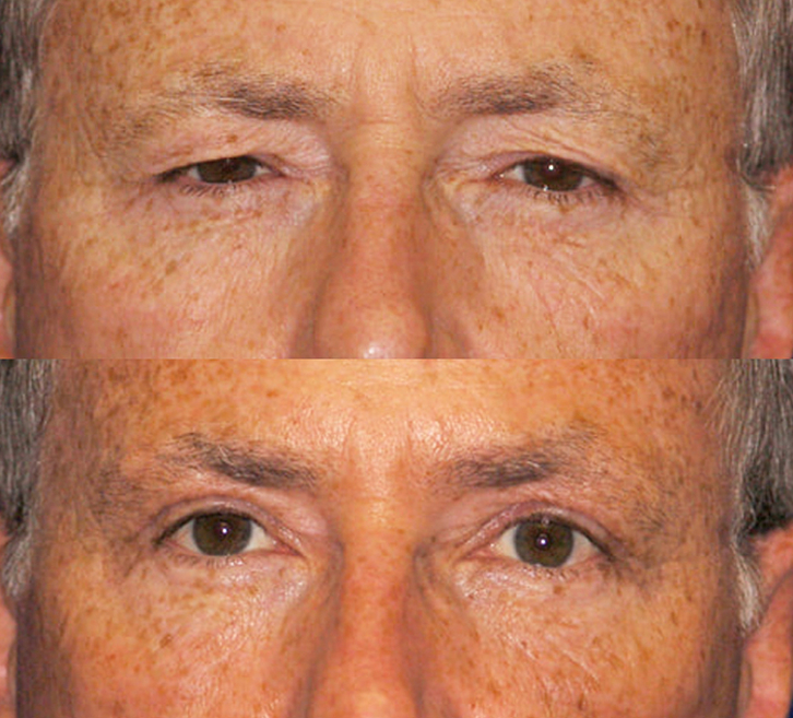 upper blepharoplasty patient 2