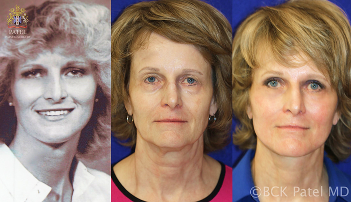 Three side-by-side portraits showing a woman's facial changes: a black and white photo of her youth, an older age, and post-procedure appearance.