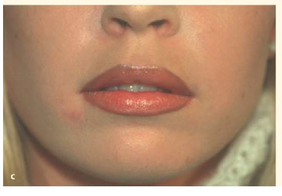 Results of fat grafting four months after the procedure.