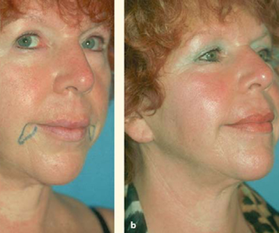 asymmetry may be isolated as seen here. Correction was obtained with appropriate fat grafts.