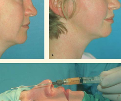 Correction of a saddle nose after a rhinoplasty which left the patient with the saddle nose deformity: fat grafts were used.