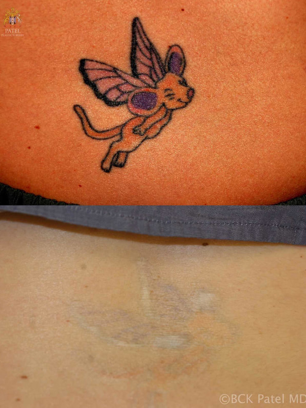 Multiple coloured tattoos take more treatments to give an improvement; also, some hypopigmentation is to be expected if there is natural colour in the person's skin