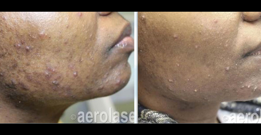 Acne on skin of color after one treatment with the Aerolase Neo. Courtesy Dr. Michael Gold MD