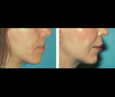 Correction of residual asymmetric lips peformed with fat grafts and secondary fillers