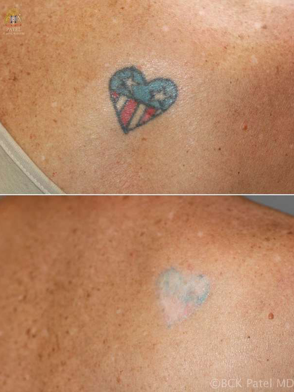 Blue, green and red tattoos need more laser treatments then darker tattoos (dark blue or black). Also, because of this, a slight hypopigmentation is to be expected