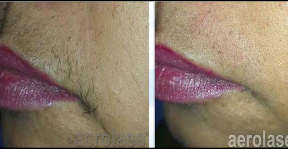 Permanent hair reduction in a patient with skin of color after five treatments using the Aerolase Neo Laser