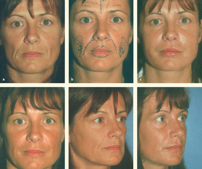 proper planning involves knowledge of anatomy, physiology and relevant surface markings to allow the surgeon to correct the various age-related changes.