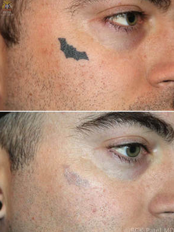 The natural colour of the skin will also show slight pigment loss with tattoo removal, especially as several laser treatments are needed