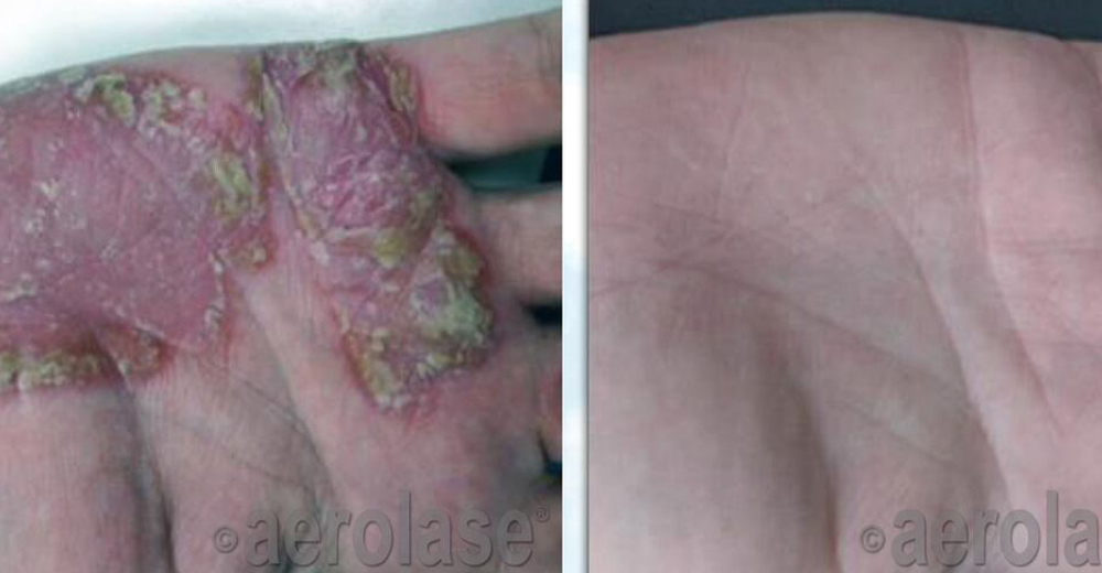 After six treatments using the Aerolase Neo: response of palm psoriasis. Courtesy Dolores Holleman