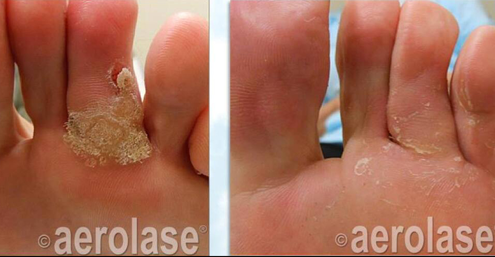 Patient who had failed to have her warts removed with wart remover, freezing, duct tape and other treatments who responded to four treatments with the Aerolase Neo laser. Courtesy Marc Garfield DPM