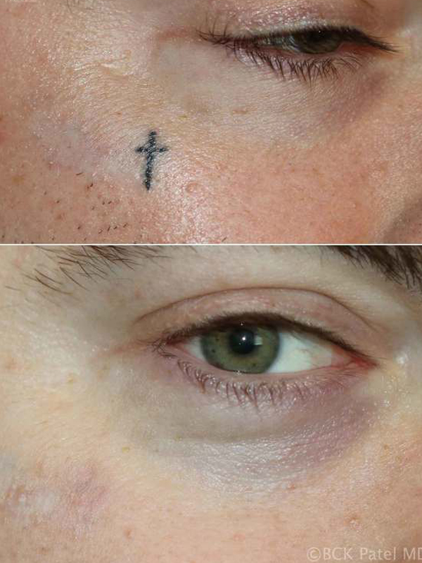 Some slight skin colour change can occur with tattoo removal