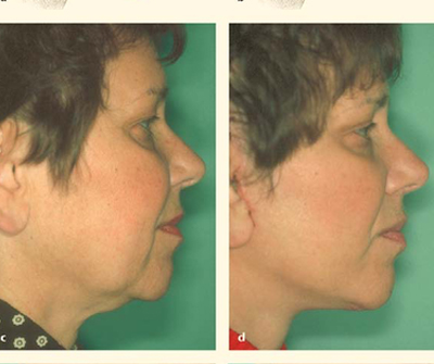 Correction of residual deformities of the chin and neck with surgery and fat grafts