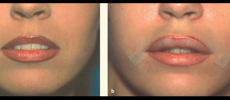 results immediately after fat grafting.