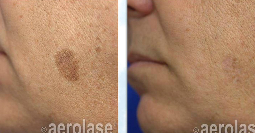 Pigmented lesion treated twice with the Aerolase Neo Laser. Coutesy Dr. Edmund Liu MD