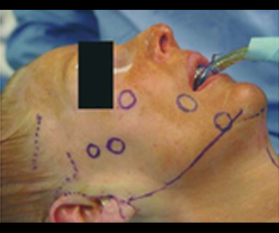 Anatomical markings of the important retaining ligaments, besides nerves and vessels and aging changes all contribute to proper planning and surgical execution