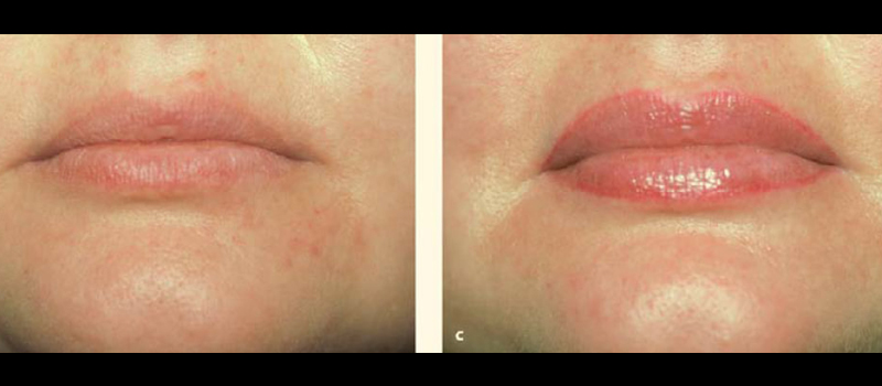 Fat grafts to upper and lower lips showing a nice improvement in the volume of the lips