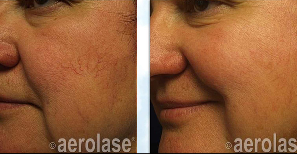 Facial veins after two treatments with the Aerolase Neo. Courtesy Dr. Edward Zimmerman MD