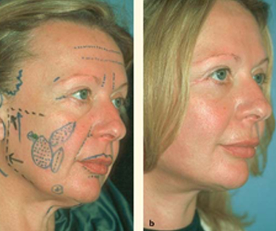 An example of how we plan surgery with proper markings and plans