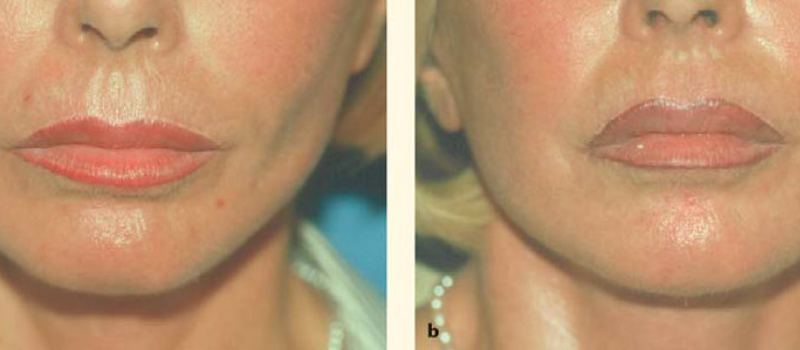 fat grafts to lips for volume