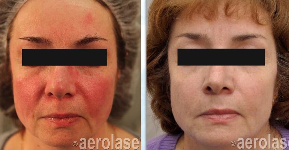 Red face of Acne Rosacea after two treatments with the Aerolase Neo Laser. Courtesy Dr. Natalja Geraskova MD