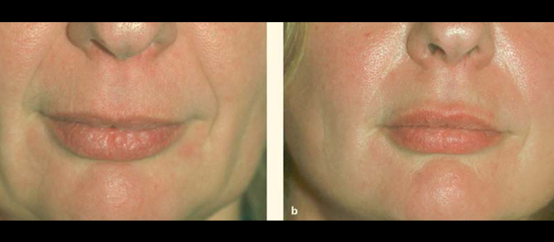 Use of SMAS tissue during a facelift to augment the lips