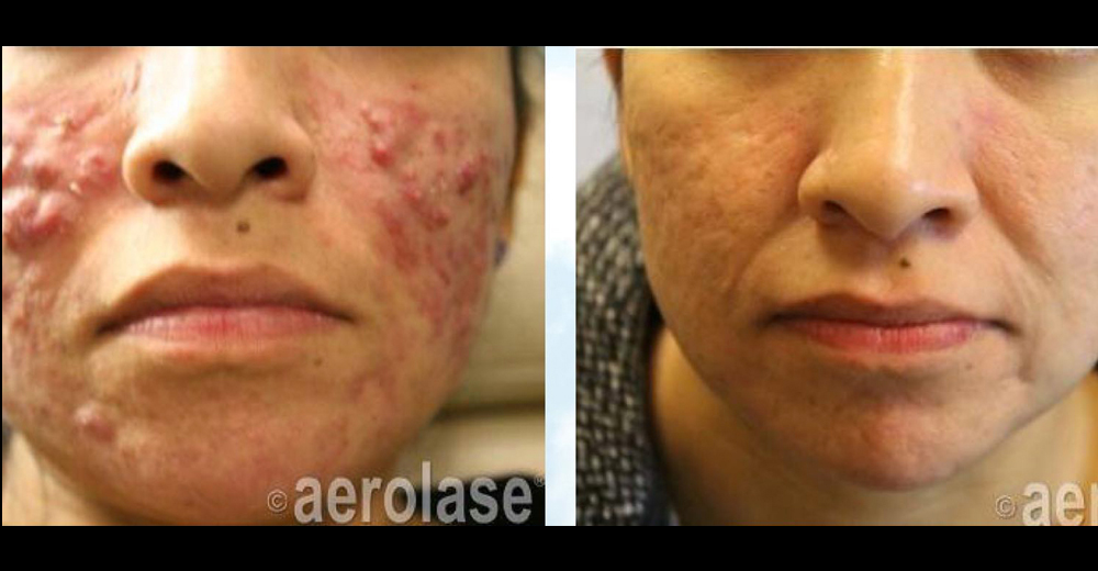 Cystic acne after six treatments with the Aerolase Neo