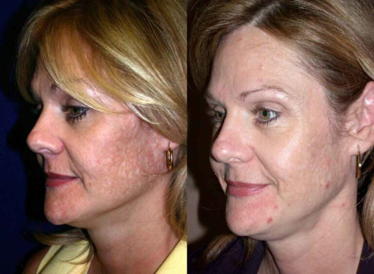 Some blemishes are white and will require treatment of the surrounding tissues to allow one to camouflage them