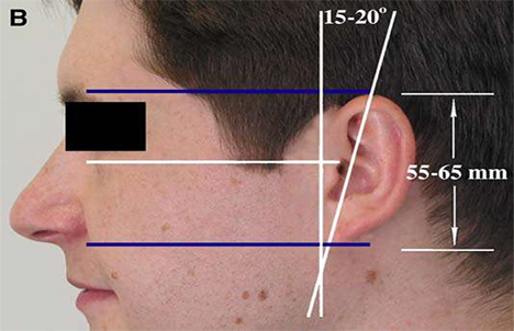 Surface relational anatomy of the ear
