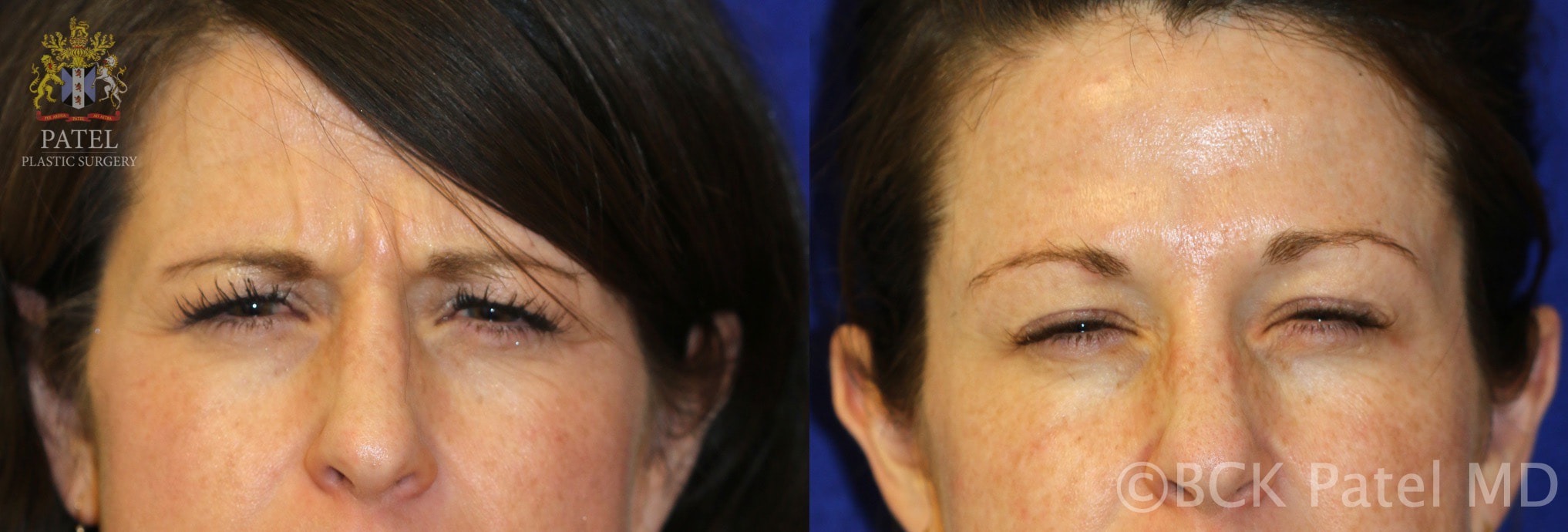 Anderson Rebecca Pre Post Botox