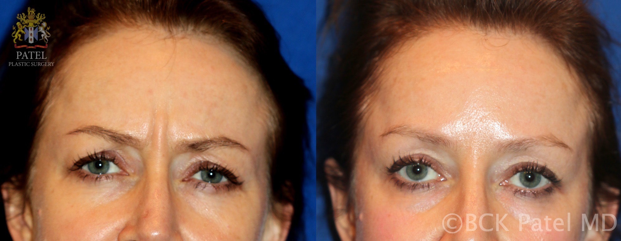 Arnold Olga Botox Pre Post