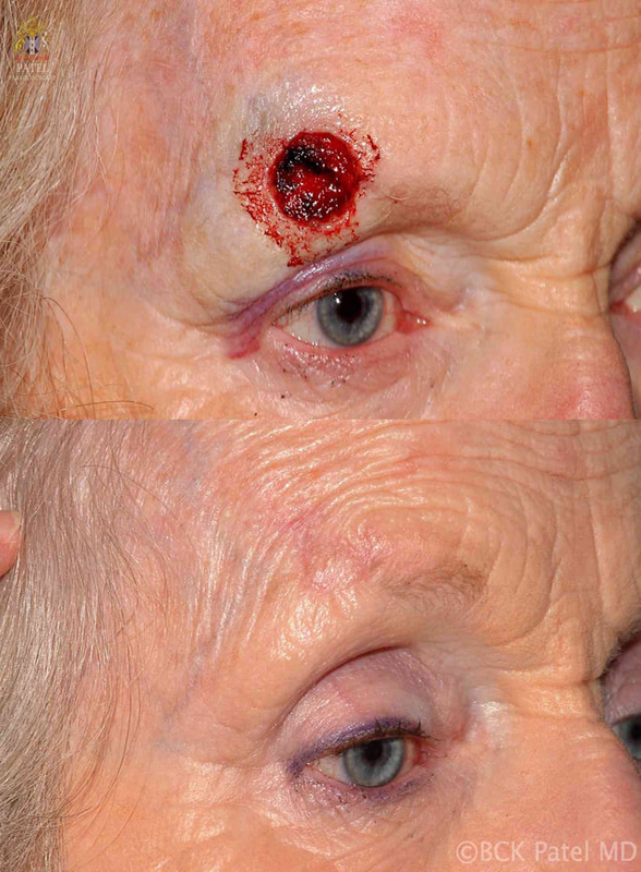 As with mole removal, defects left after Mohs resection of tumors (squamous cell carcinoma here) should be repaired using the best flaps and grafts to reconstruct the important structures like brows, eyelid position, preservation of hair, restoration of normal anatomy and minimal scarring. The same principles are applied by a reconstructive and cosmetic surgeon to all surgeries, be it cosmetic or reconstructive