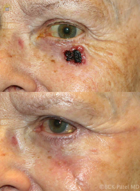 Resection and removal of a large tumor (basal cell carcinoma), using advanced flaps and grafts yielding a beautiful cosmetic result. Surgery by Dr. BCK Patel MD, FRCS