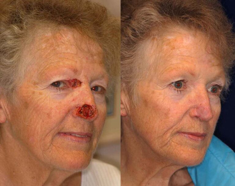 Reconstruction after removal of moles or cancer requires proper planning of the reconstruction. The result can be very satisfying