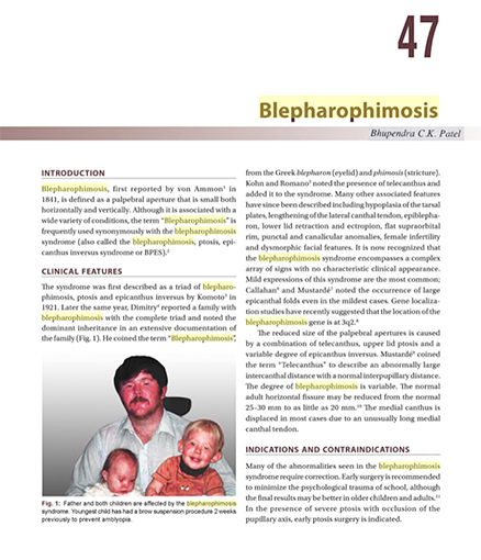 blepharophimosis chapter by dr. bck patel md