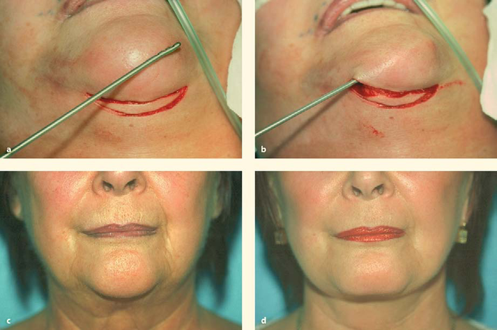 A number of different techniques are used to address the “witch’s chin”. Nice reduction in the witch’s chin can be achieved giving the mouth, lower face, jawline and neck a more congruous look.