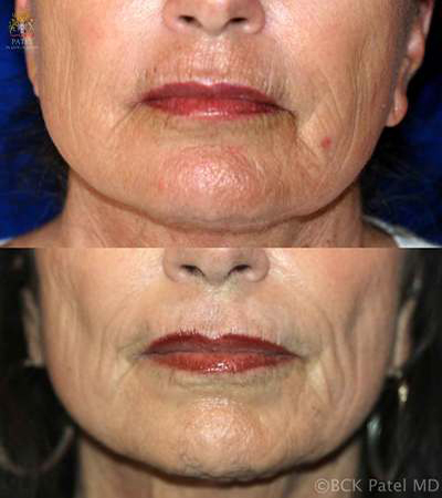 christensen-rosemary-pre-post-lips-co2-5-years-copy