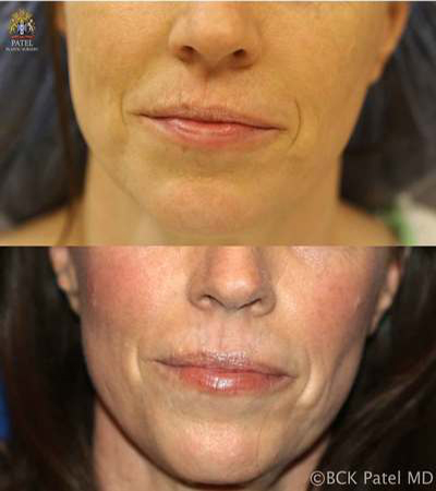christiansen-susan-pre-post-co2-lips-copy_1