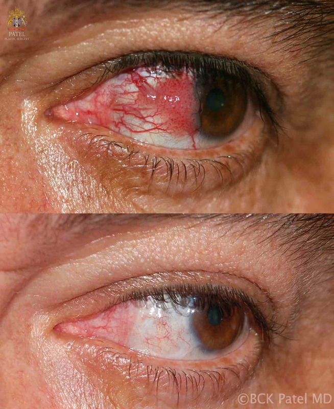 Removal of cancerous "mole" growing on an eyeball by Dr. BCK Patel MD, FRCS in Salt Lake City and St. George, Utah: Beautiful cosmetic tumor removal