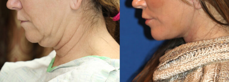 There is no substitute for a beautifully-performed facelift and necklift when one is seeking the maximal improvement in the jawline, the jowls and the neck.