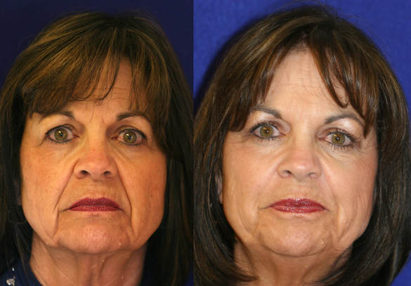 the nasolabial and the melolabial folds can be filled with the appropriate filler to give a pleasing improvement in the depth of the folds. This is not in any way a lifting procedure and is not a substitute for a good facelift.