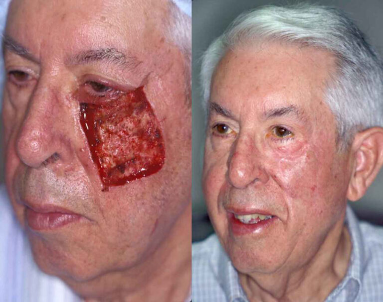 No reconstruction can be performed without some scars, but with proper plastic surgery techniques, these can be kept to a minimum