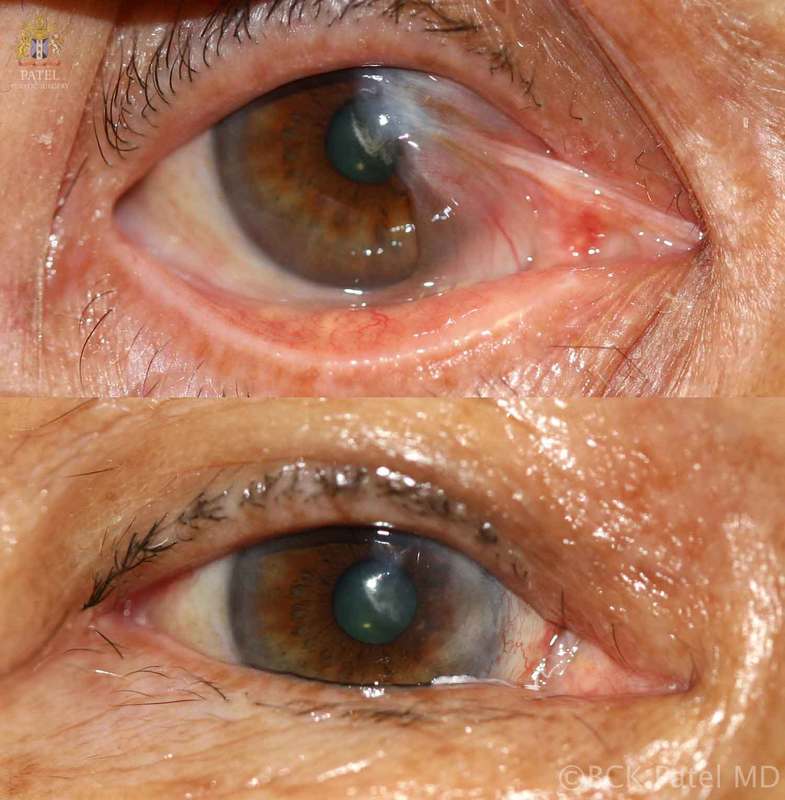 irlbeck-tsuneko-pre-post-ptery_2_orig