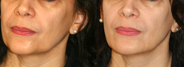 no surgery was performed. Cleverly injected fillers can give an immediate result with a more youthful face and a stronger and straighter jawline.