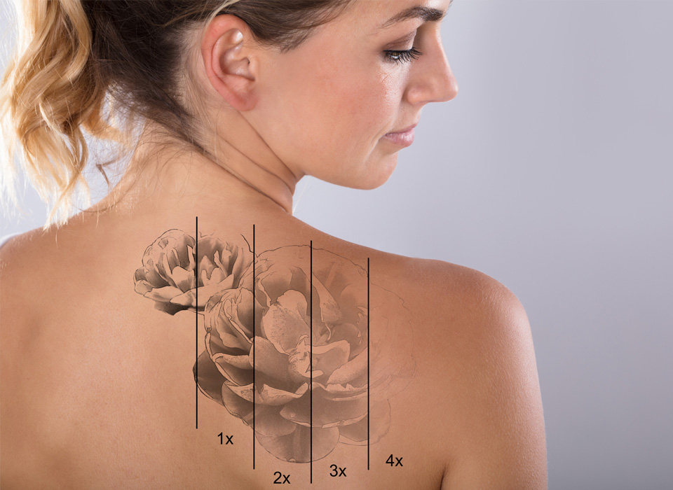 Laser Tattoo Removal On Woman's Shoulder Against Gray Background